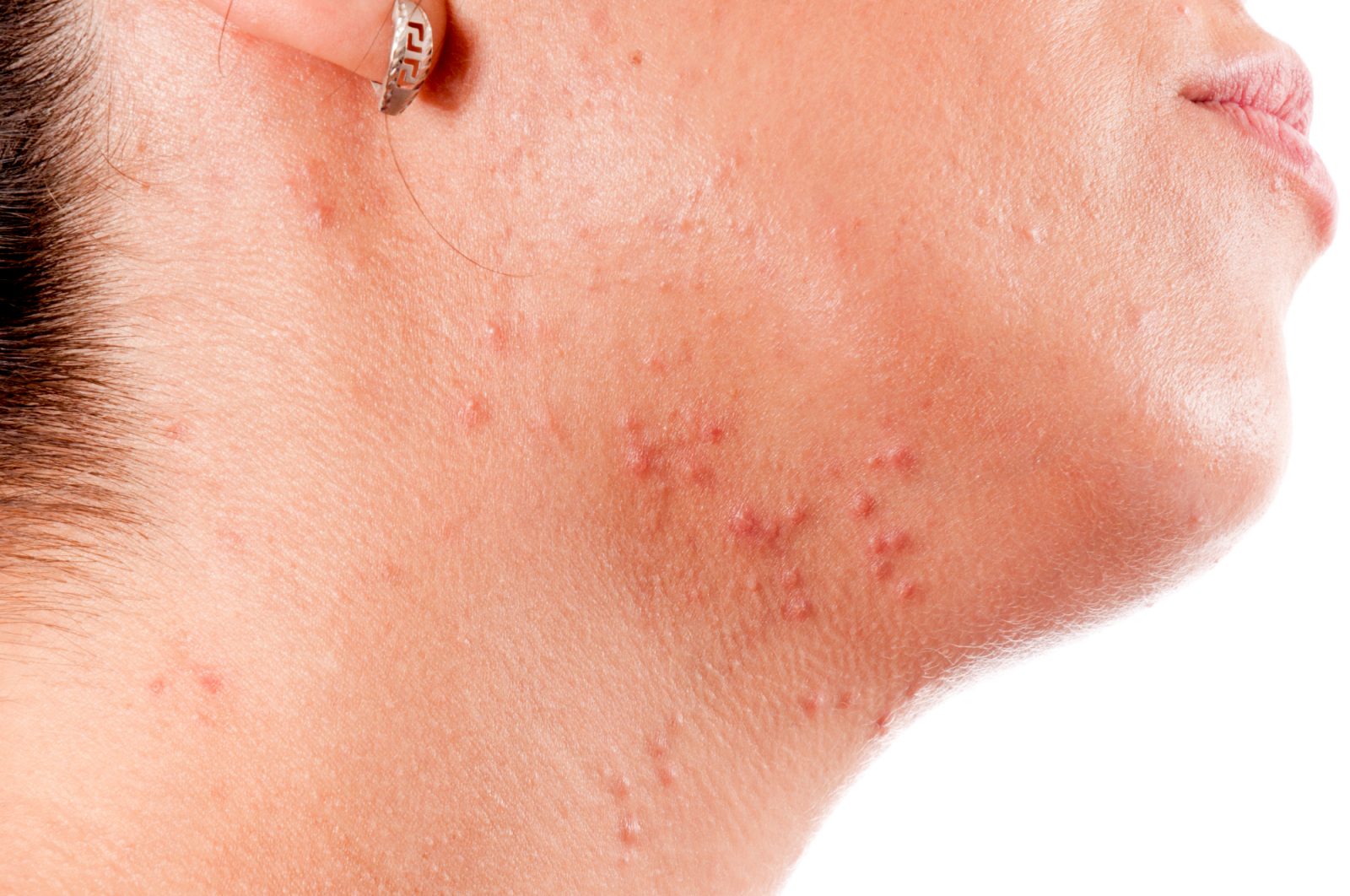Kaj mi je povedal dermatolog, ko sem mu povedala, da so akne pri meni še vedno problem